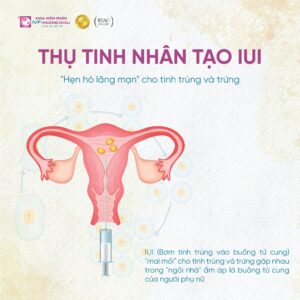IUI-hinh-minh-hoa
